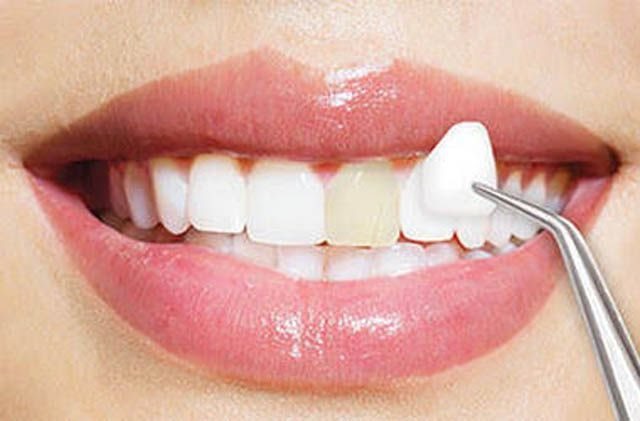 Cara Merawat Gigi Yang Baik Dan Benar